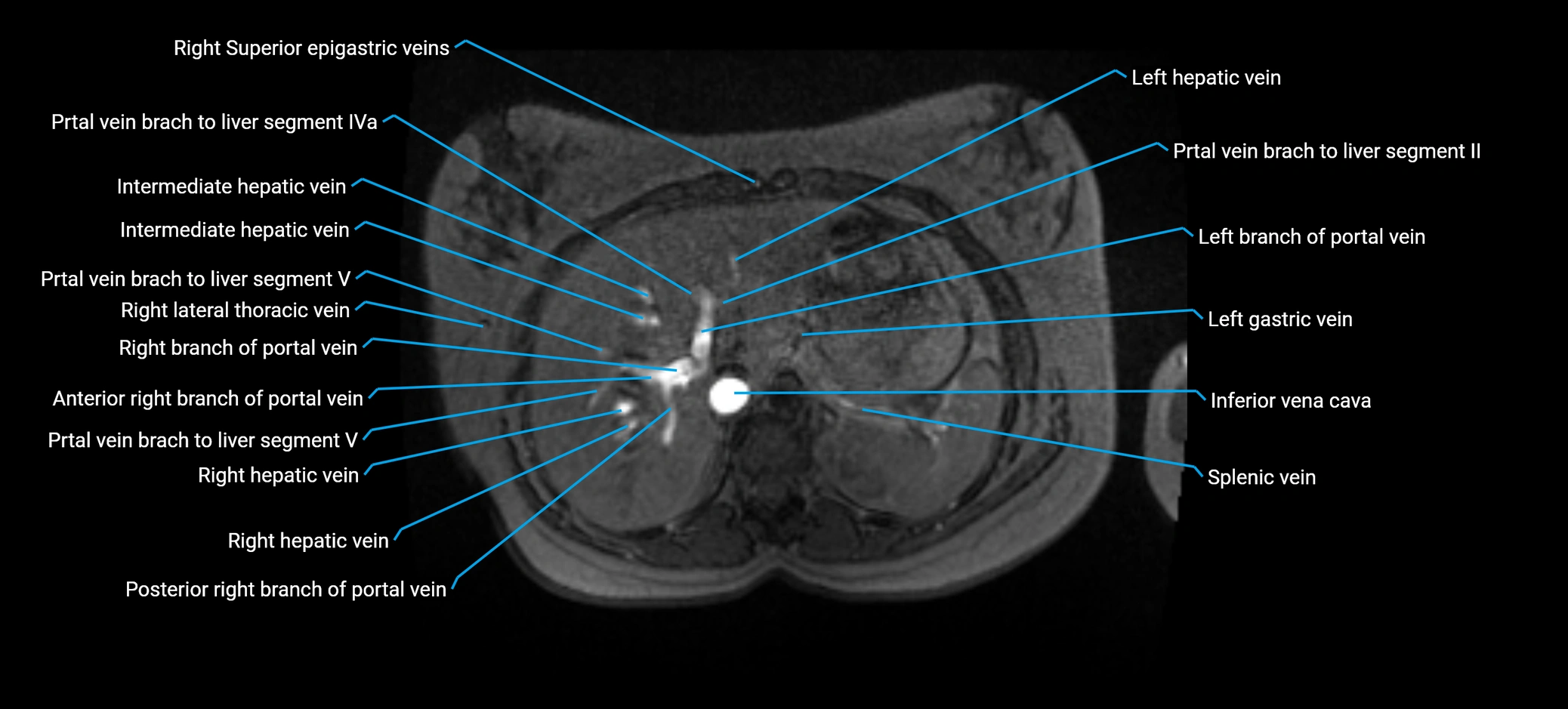 MRV abdomen pelvis & lower limb axial cross sectional anatomy labelled MRI image 38 (1).webp